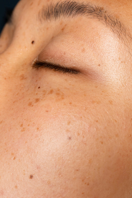 The Best Treatment For Melasma On Face: Your Ultimate Guide To Clearer, Brighter Skin