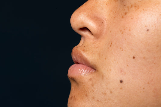 Ask Sephine’s: Skincare Solutions To Help Manage Melasma